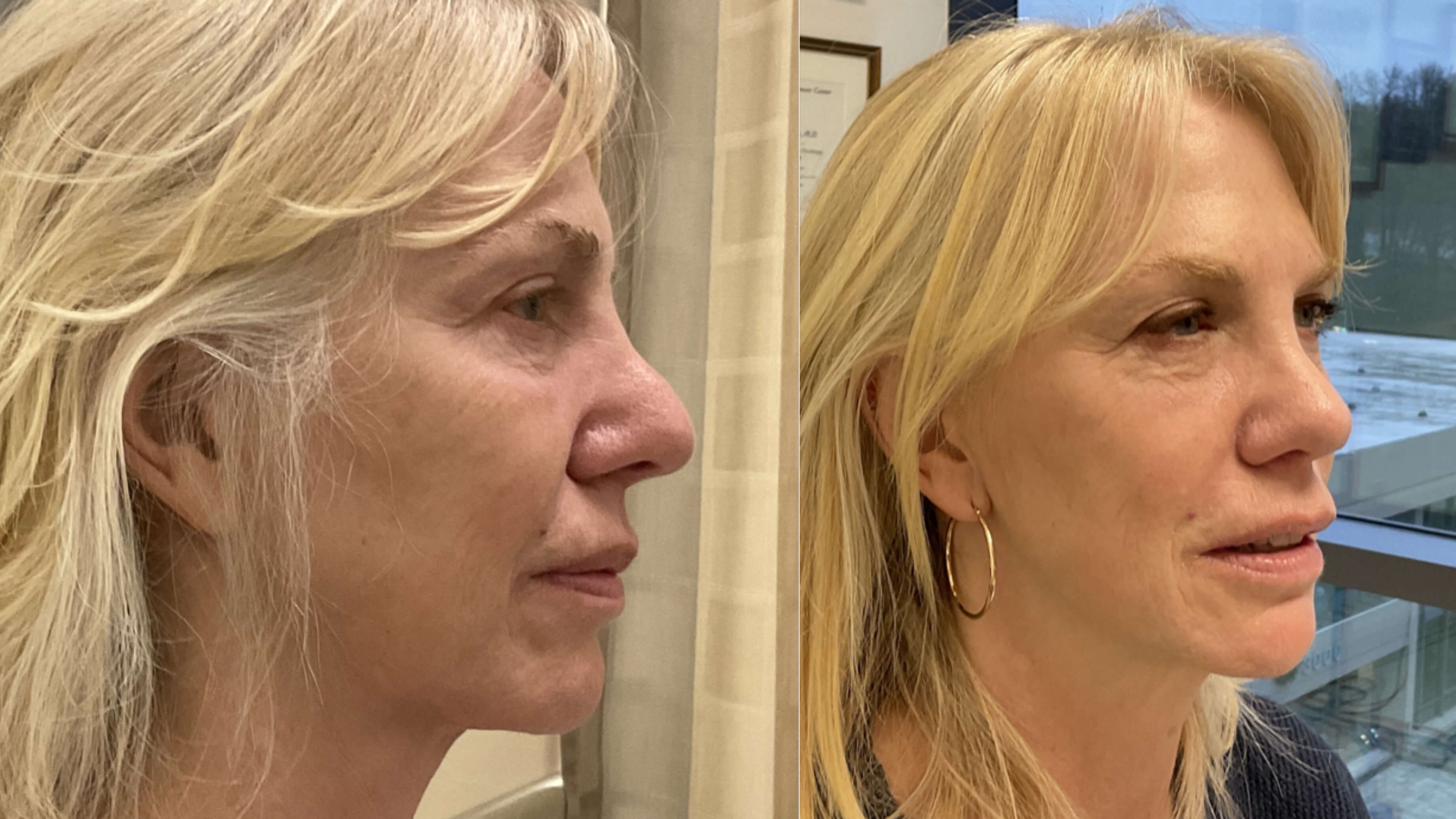 Dr Suzman Rhinoplasty